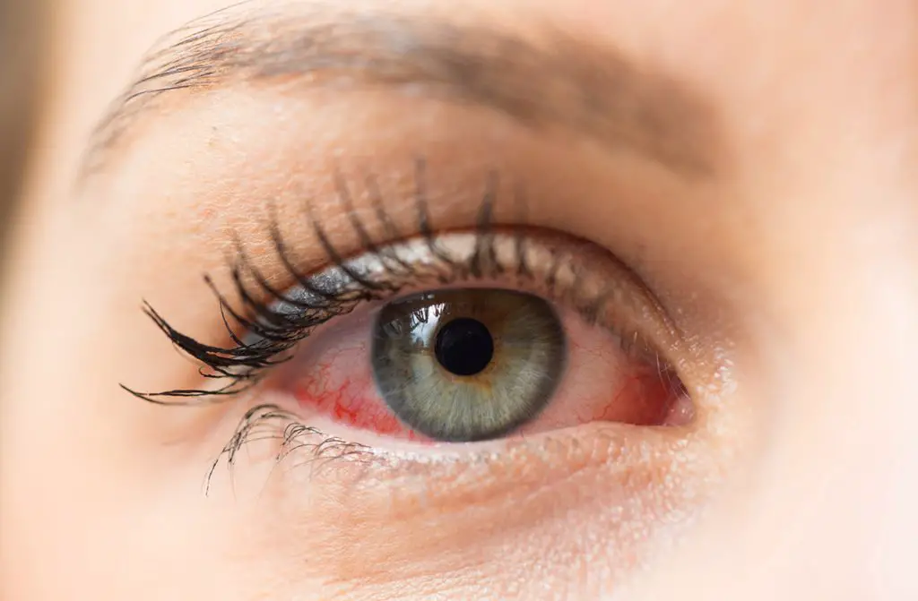 remedios caseros para la conjuntivitis que es remedios caseros para la conjuntivitis que es