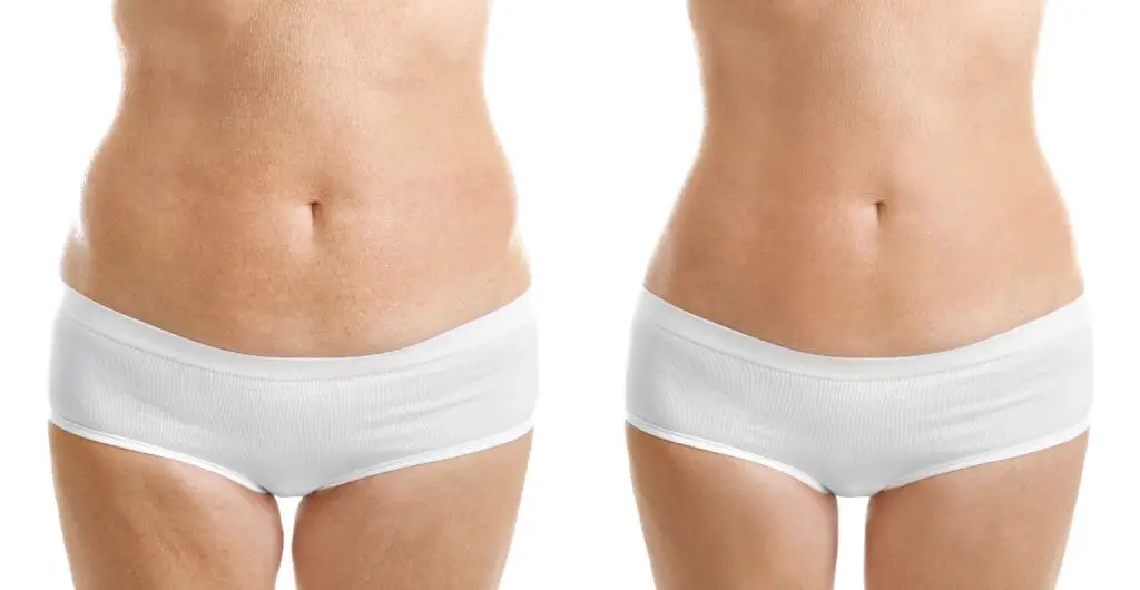 mesoterapia antes y después mesoterapia antes y después