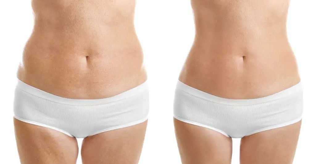 lipoescultura sin cirugia antes y despues