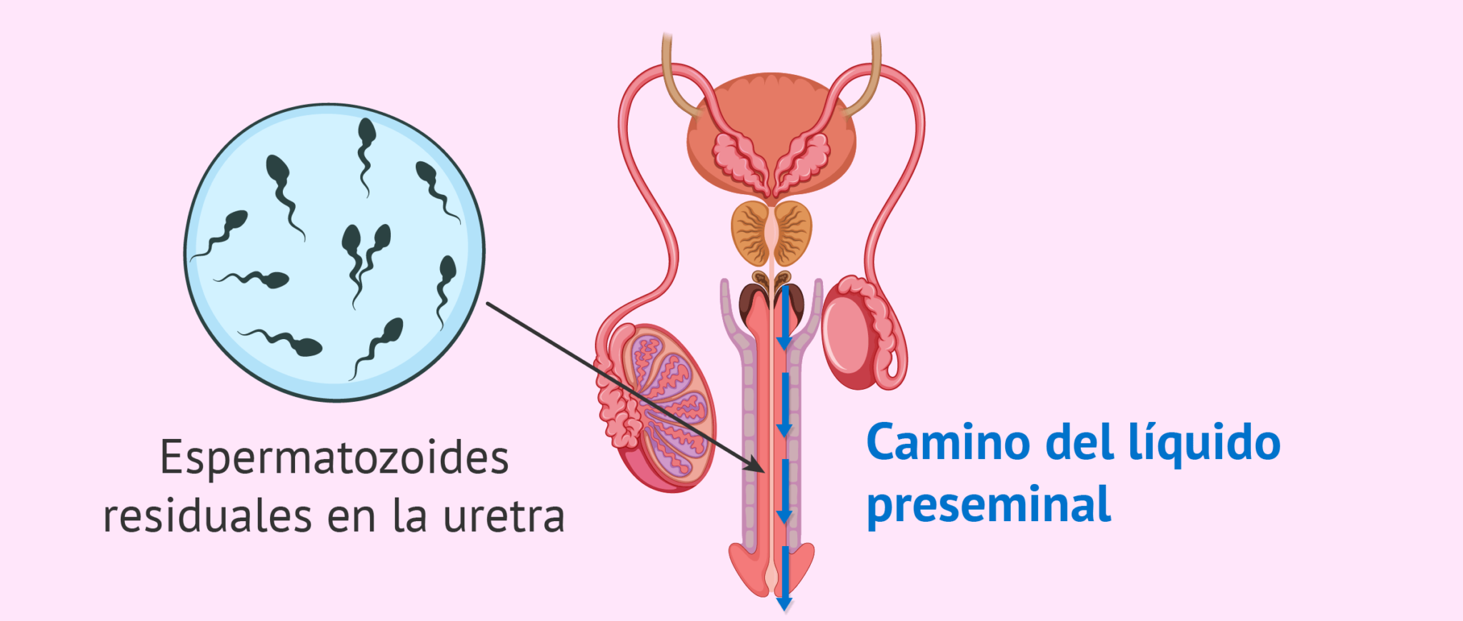 ¿Qué probabilidad hay de quedar embarazada con el líquido preseminal?
