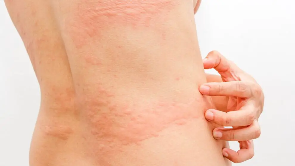Alergias de piel ¿Cuáles son las más comunes y cómo prevenirlas?