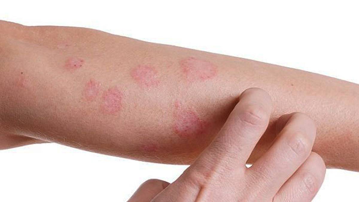 Alergias de piel ¿Cuáles son las más comunes y cómo prevenirlas?