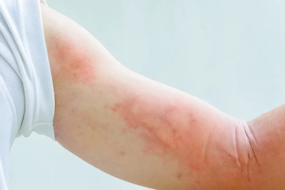 Alergias de piel Cuáles son las más comunes y cómo prevenirlas