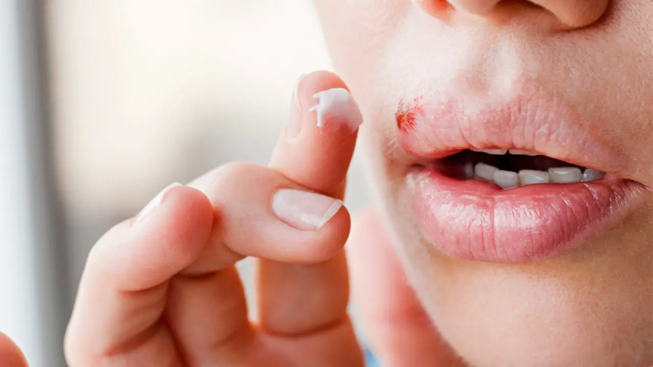 remedio caseros herpes labial cremas tratamientos